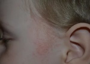 Сыпь за ушком у новорожденного