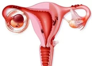 Киста левого яичника аденомиоз