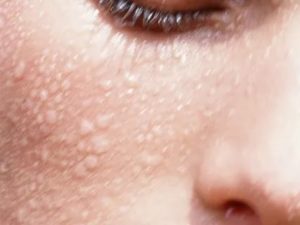 Мелкие белые пузырьки на лице