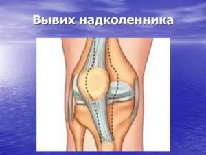 Растяжение коленного сустава, вывих надколенника