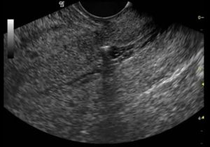 Рубец на матке 4мм