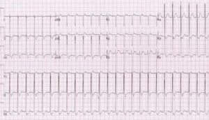 Тахикардия при ходьбе