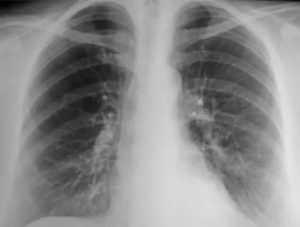 Кальцинаты в лимфоузлах легкого у ребенка