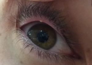 Пузырик в уголке глаза