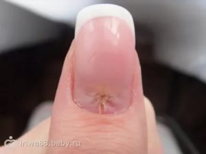 Трещина на ногте у кутикулы