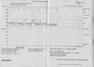 Расшифровка КТГ, оценка по Фишер 8, Кребс 10, нестрессовый тест положительный
