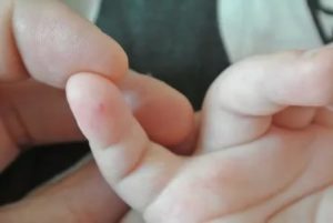 Твёрдый прыщ на пальце у ребёнка