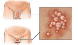 Прыщ между большой и малой половой губой