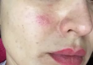 Розовое пятно на щеке