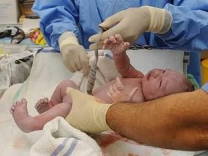 Истинный узел пуповины. Как быть? Рожать самой или кесарево?