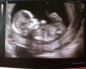 УЗИ 12 недель и 3 дня