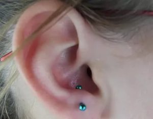 Темно синее образование возле прокола уха