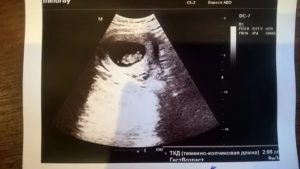 Беременность 10 недель, красные выделения