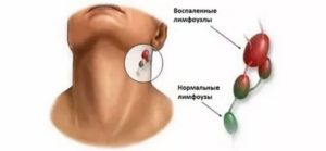 Увеличение лимфоузлов и стоматит