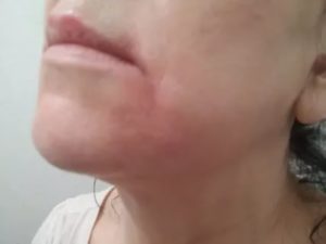 Розовое пятно на щеке