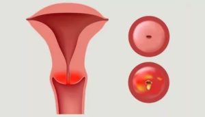 Цитограмма умеренного эндоцервицита