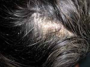 Налет на коже головы