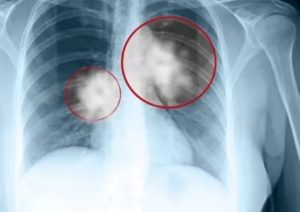 Новобразование в легких