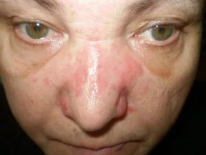 Припухлость возле носа и идёт под глаз после лечения зуба