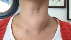 Узловой зоб при нормальных гормонах