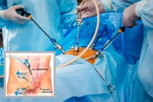 Реабилитация после операции на паховую грыжу