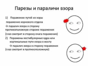 Парез взора