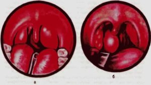 Шарик на задней стенке глотки