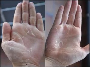 Зимой у дочери облазит кожа на ладошках и пальчиках