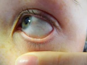Пузырик в уголке глаза