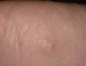 Зуд кожи, шелушение