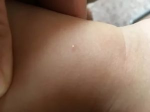 Сыпь, похожая на ветрянку