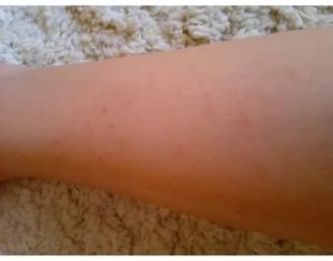 Сыпь на ноге при беременности