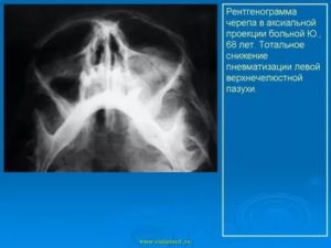 Снижение пневматизации гайморовых пазух за счет пристеночных наслоений