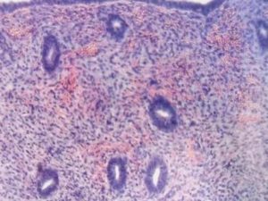 Результат кольпоскопии, пролиферация железистого эпителия