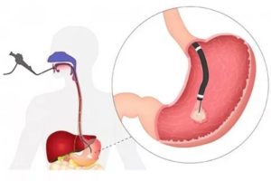 Боль после биопсии желудка