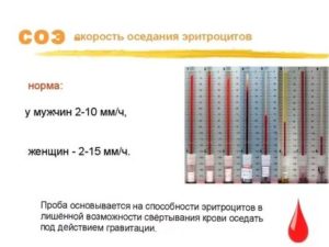 Повышено соэ, остальные показатели в норме