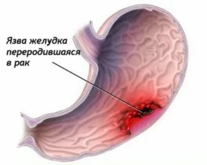 Свекрови рак желудка