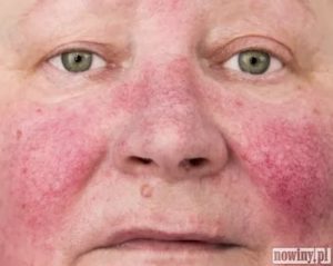 Проблема кожи лица, покраснения, жжения в район щек