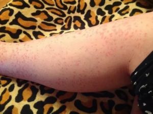 Сыпь на ноге при беременности