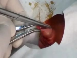 Гной после лазерного обрезания