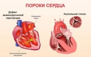 Как жить с пороком сердца?
