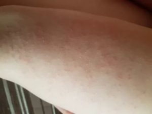Сыпь на руках и ногах без зуда