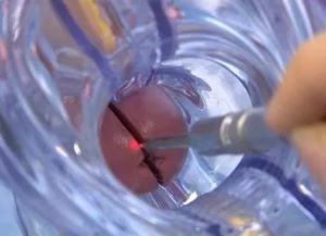 Установка спирали после прижигания эрозии