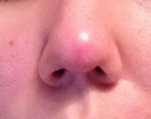 Опухло крыло носа