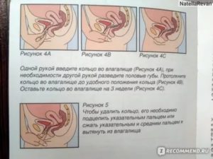 Новаринг менструация