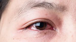 Опух, покраснел и слезится правый глаз