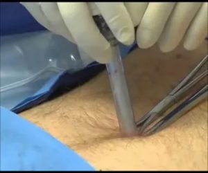 Ревизия раны после операции