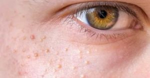 Мелкие белые пузырьки на лице