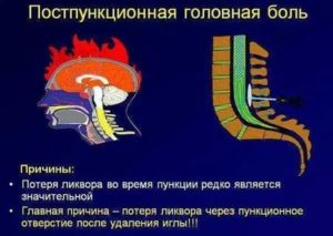 После спинальной анестезии сильно болит шея и голова