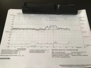 Расшифровка КТГ, оценка по Фишер 8, Кребс 10, нестрессовый тест положительный